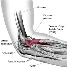 tennis elbow