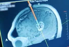 Laser Ablation Medical Technology