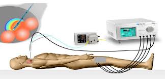 Chemical Ablation Medical Technology